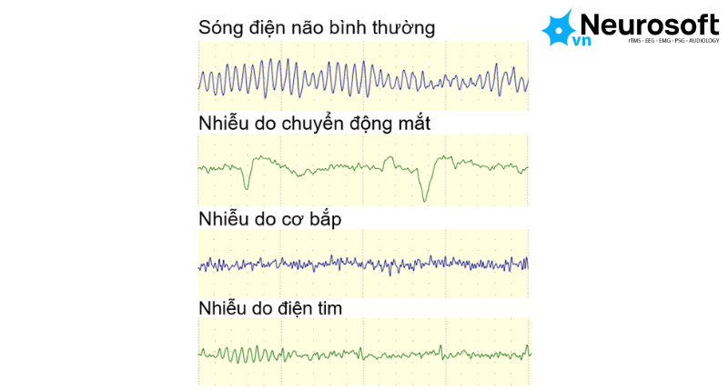 điện não tiếng anh là gì